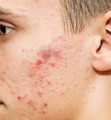 3-Pimples-And-Acne