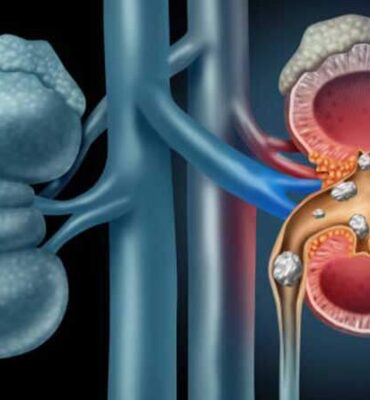 5-Kidney-Stone