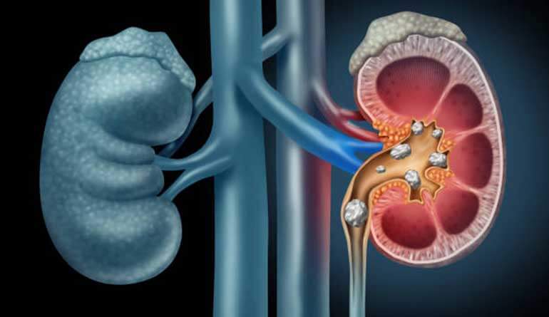 5-Kidney-Stone